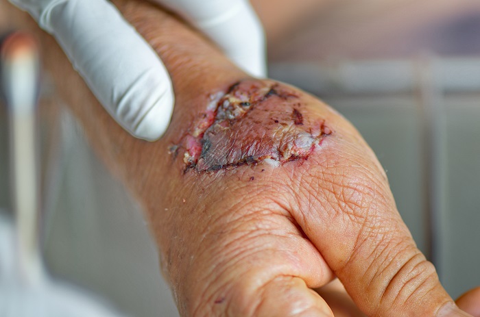 Dog bite injury in Columbus Ohio
