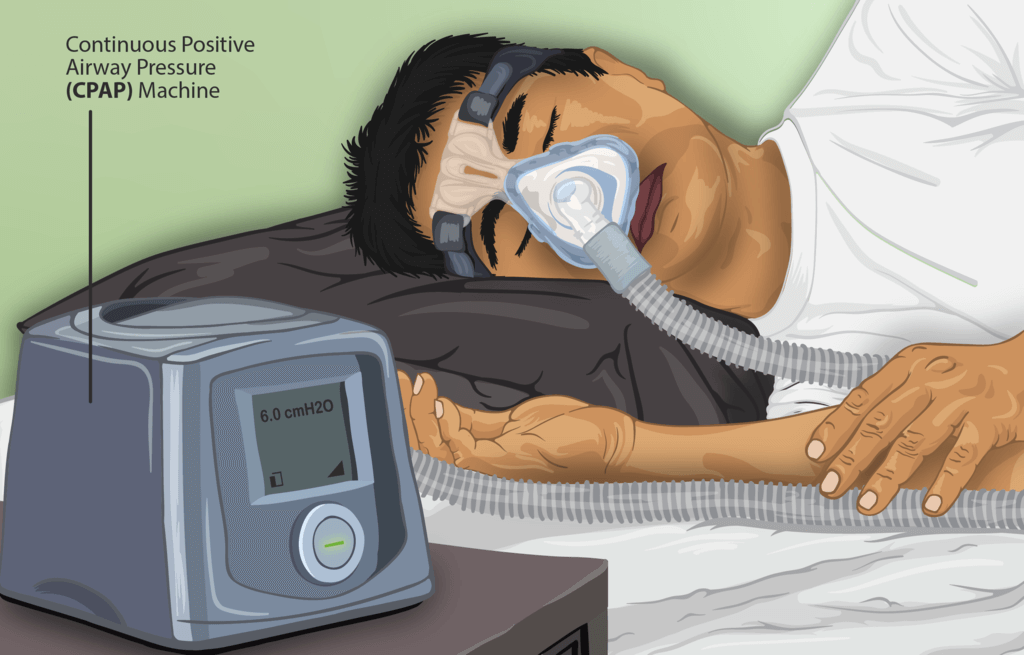 philips cpap lawyers in columbus ohio