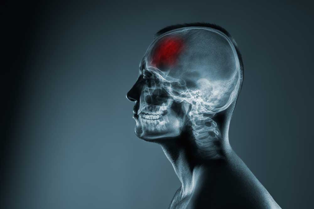 What Are Some Signs of a Serious Brain Injury?